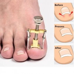 Ingrown Toenails Correction...