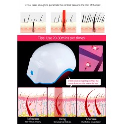 Laser Helmet to Help with Hair Restoration