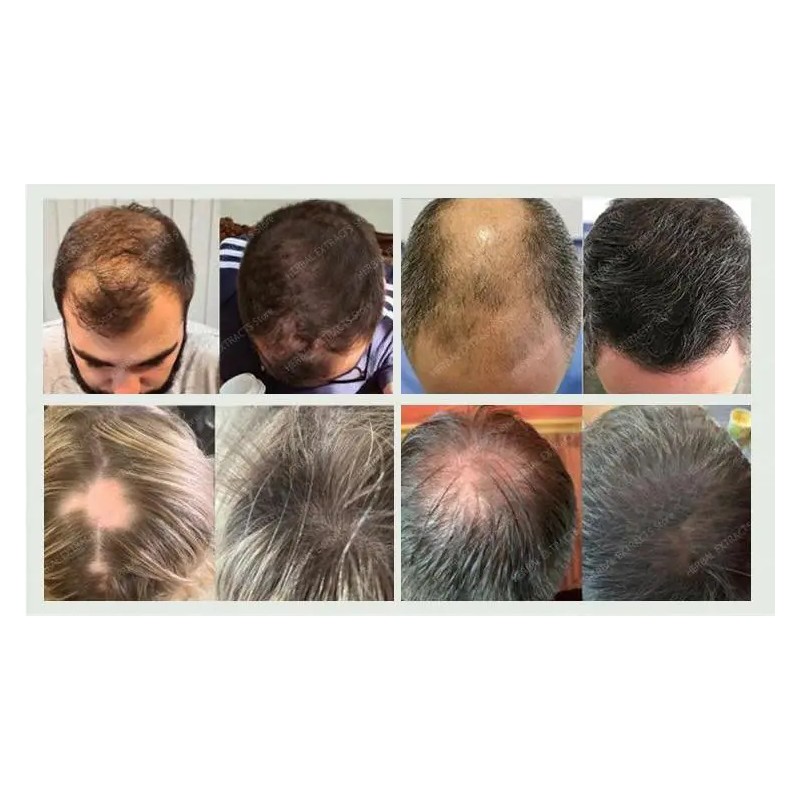 Hair Growth Serum For Baldness