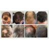 Hair Growth Serum For Baldness