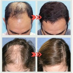 Hair Growth Serum For Baldness