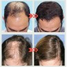 Hair Growth Serum For Baldness