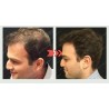 Hair Growth Serum For Baldness